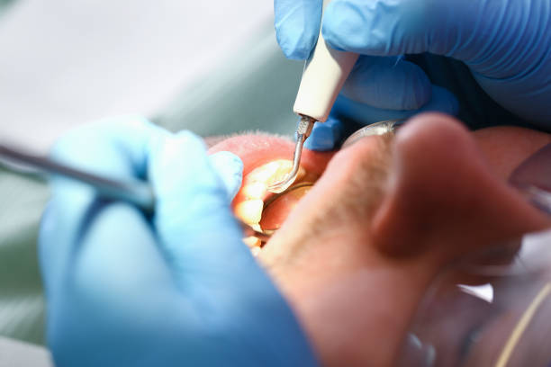 Best Emergency Treatment for Dental Infections or Abscesses in Shady Shores, TX